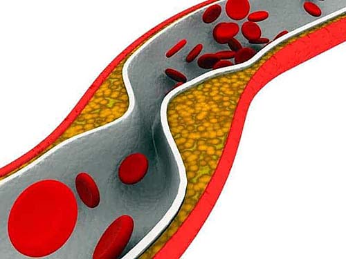 Controle de LDL-C, o “colesterol ruim”, diminui infarto do miocárdio e AVC